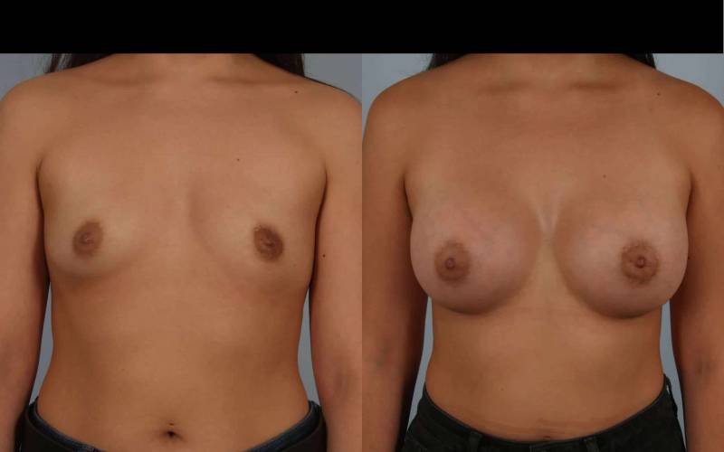 before and after breast augmentation female patient front view case 885