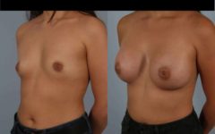 before and after breast augmentation female patient left diagonal view case 885