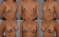 before and after breast augmentation female patient multiple angle view case 885