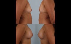 before and after breast augmentation female patient right and left side view case 885