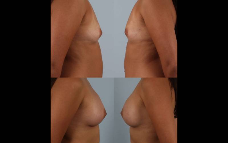before and after breast augmentation female patient right and left side view case 885