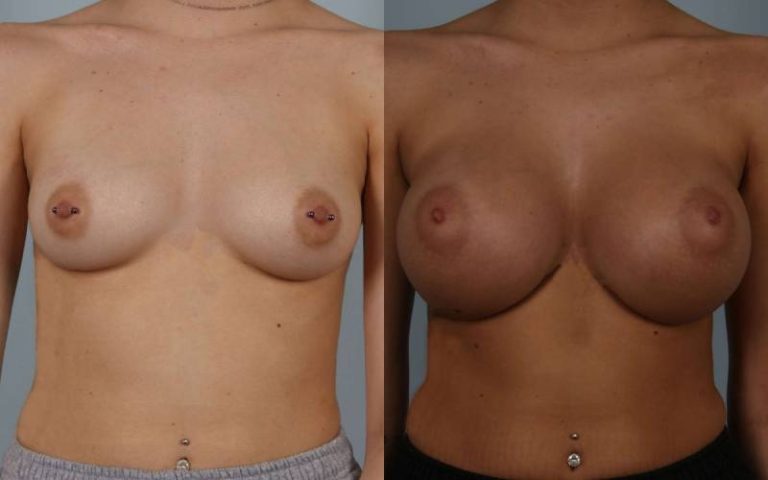 before and after breast augmentation female patient front view case 1120