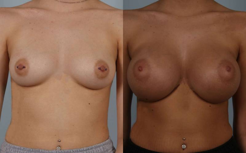 before and after breast augmentation female patient front view case 1120