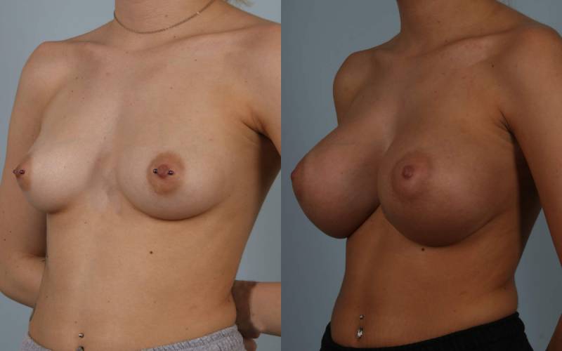before and after breast augmentation female patient left diagonal view case 1120