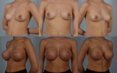 before and after breast augmentation female patient multiple angle view case 1120