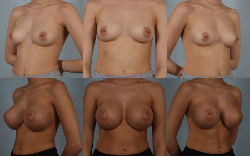 before and after breast augmentation female patient multiple angle view case 1120
