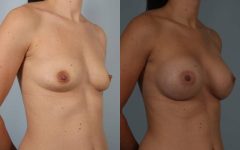 before and after breast augmentation female patient right diagonal view case 1124