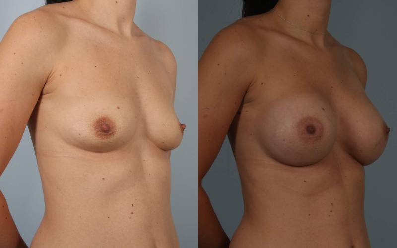 before and after breast augmentation female patient right diagonal view case 1124
