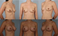 before and after breast augmentation female patient multiple angle view case 1124