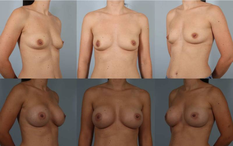 before and after breast augmentation female patient multiple angle view case 1124