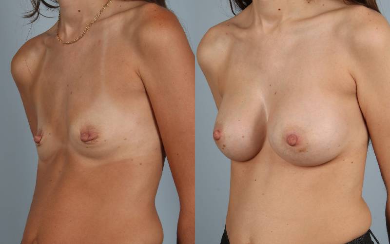 before and after breast augmentation female patient left diagonal view case 1226