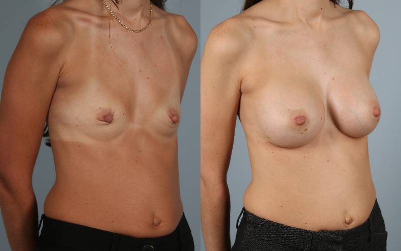 before and after breast augmentation female patient right diagonal view case 1226