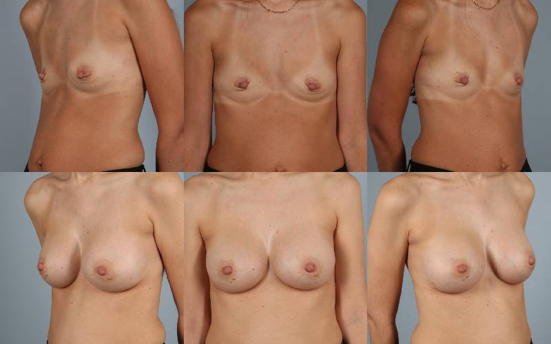 before and after breast augmentation female patient multiple angle views case 1226