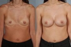 before and after breast augmentation front view case 1226