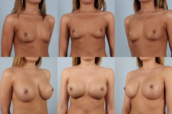 before and after breast augmentation multiple angles view case 1150