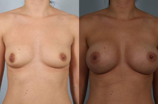 before and after breast augmentation front view case 1124