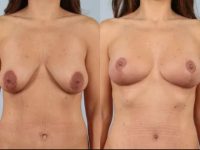 before and after breast lift auto-augmentation non-implant lift front view case 2168