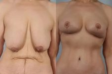 before and after breast lift auto-augmentation non-implant lift front view case 2121