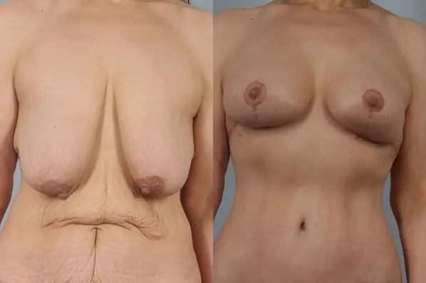 before and after breast lift auto-augmentation non-implant lift front view case 2121