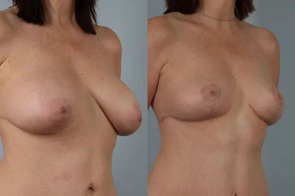 before and after breast lift auto-augmentation non-implant lift right angled view case 2117
