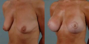before and after breast lift with implants female patient left diagonal view case 3010