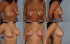 before and after breast lift with implants female patient multiple angle view case 3005