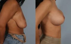 before and after breast lift with implants female patient right side view case 3005