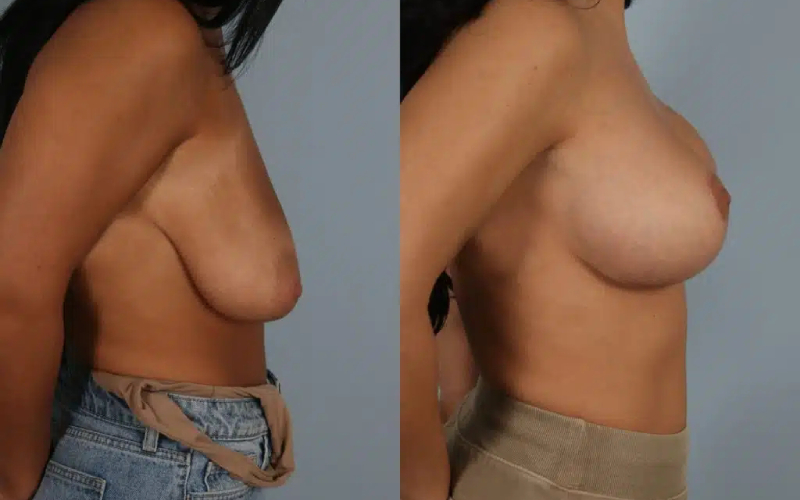 before and after breast lift with implants female patient right side view case 3005