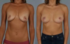 before and after breast lift with implants female patient front view case 2965