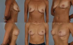 before and after breast lift with implants female patient multiple angle view case 2965