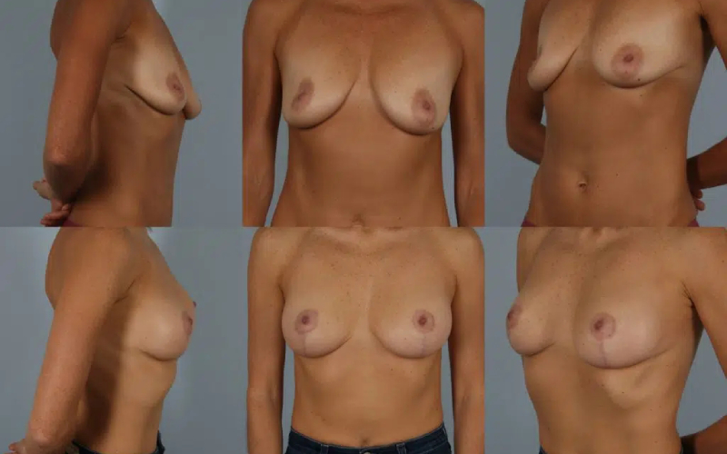 before and after breast lift with implants female patient multiple angle view case 2965