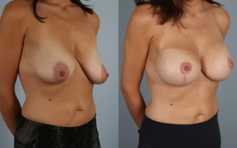 before and after breast lift with implants female patient right diagonal view case 2975