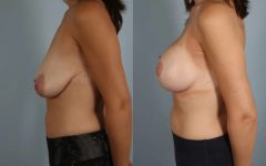 before and after breast lift with implants female patient left side view case 2975
