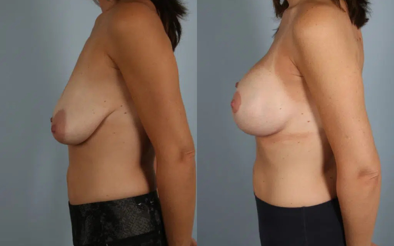 before and after breast lift with implants female patient left side view case 2975