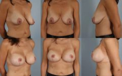before and after breast lift with implants female patient multiple angle view case 2975