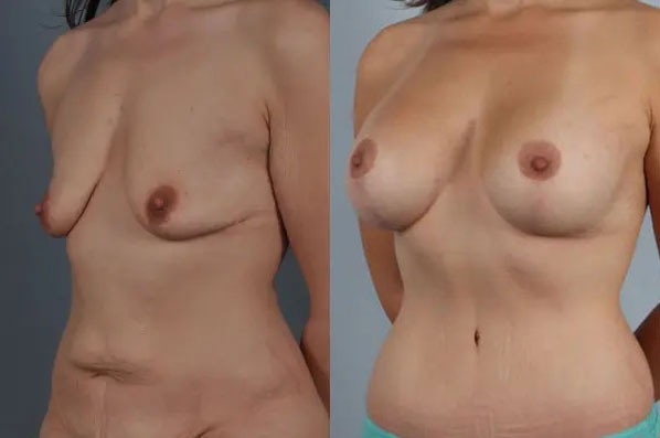 before and after breast lift with implants left angled view case 2941