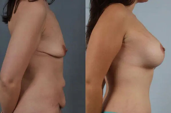 before and after breast lift with implants right side view case 2941
