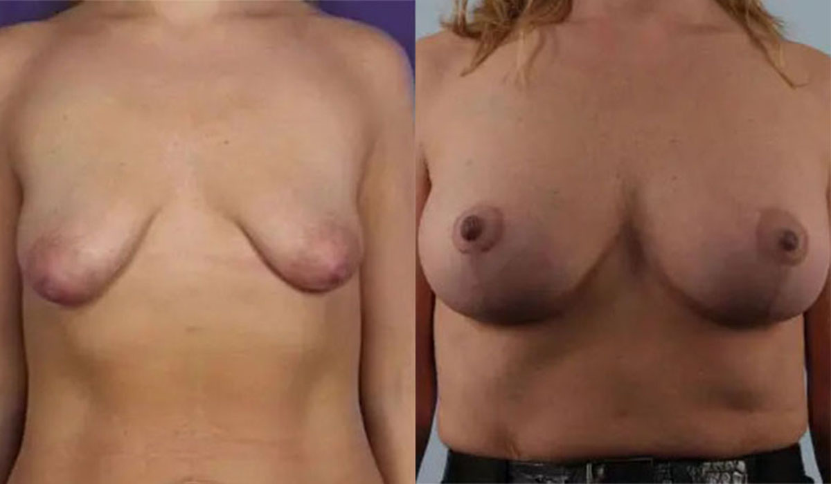 before and after breast lift with implants front view case 2865
