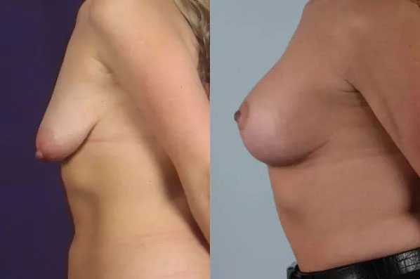 before and after breast lift with implants left side view case 2865
