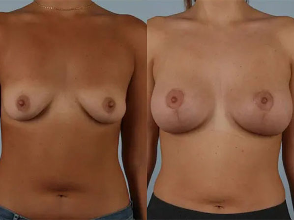 before and after breast lift with implants front view case 2841