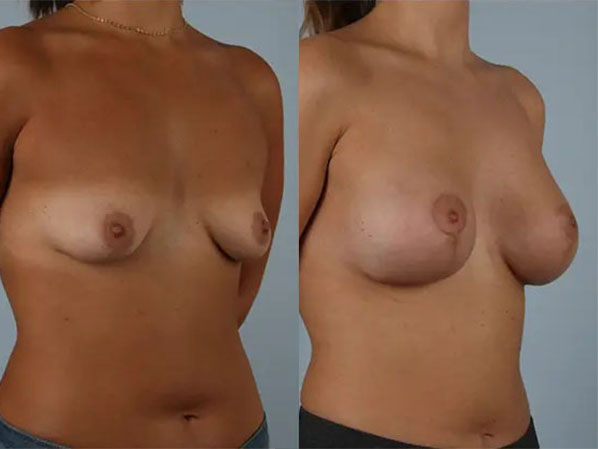 before and after breast lift with implants right angled view case 2841