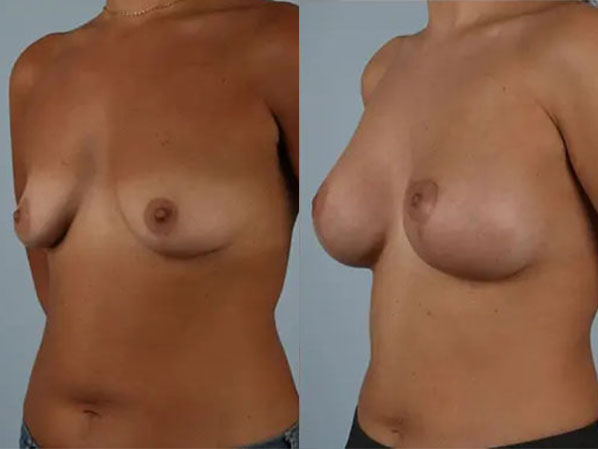 before and after breast lift with implants left angled view case 2841