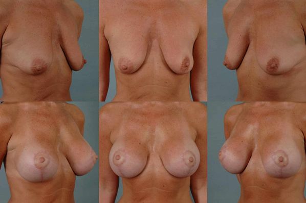 before and after breast lift with implants multiple angles view case 3010