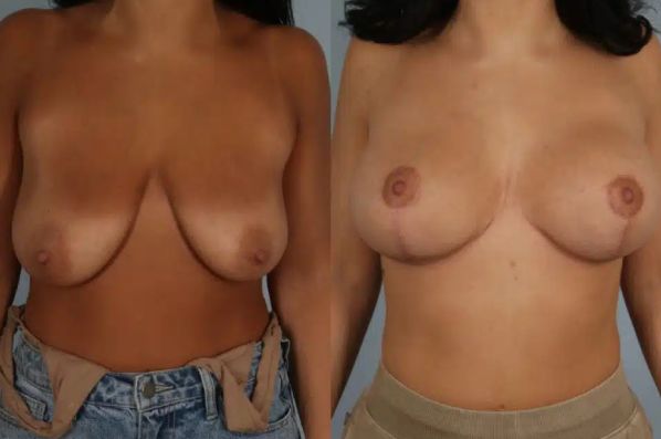 before and after breast lift with implants front view case 3005
