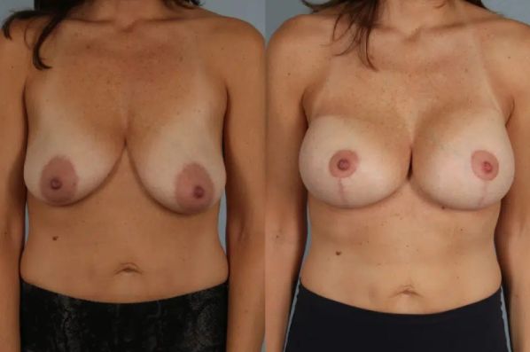 before and after breast lift with implants front view case 2975