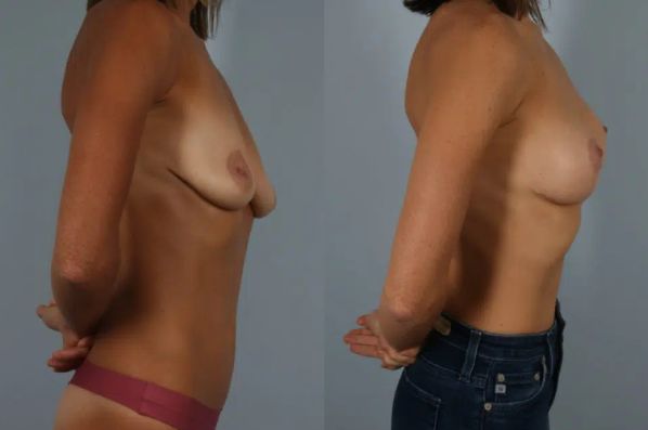 before and after breast lift with implants right side view case 2965