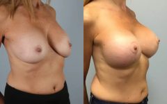 before and after breast revision female patient right diagonal view case 3427