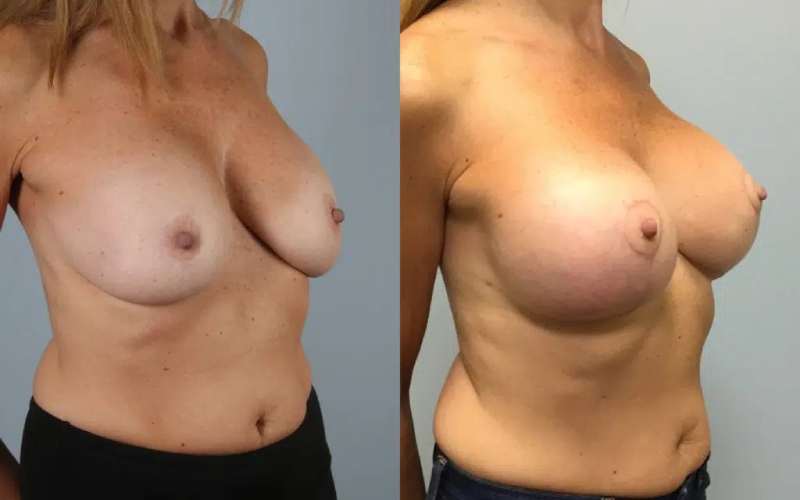 before and after breast revision female patient right diagonal view case 3427