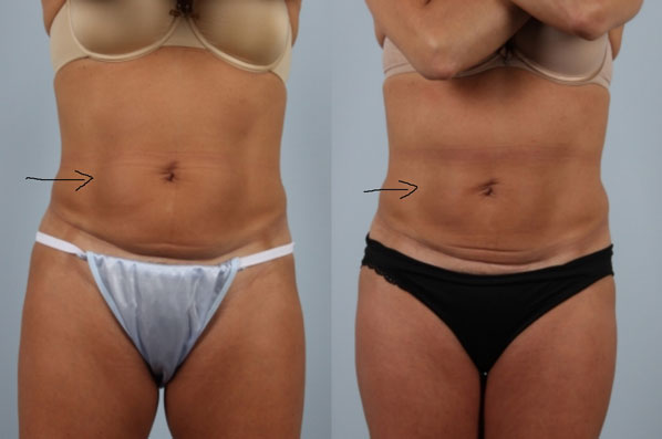 before and after coolsculpting front view female patient case 700