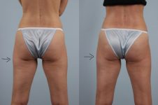before and after coolsculpting back lower view female patient case 724